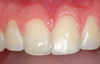 After-Chipped tooth fragment