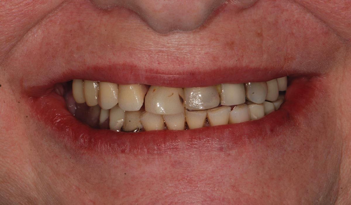Before-dentures