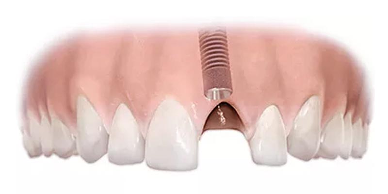 implants tooth replacement 01