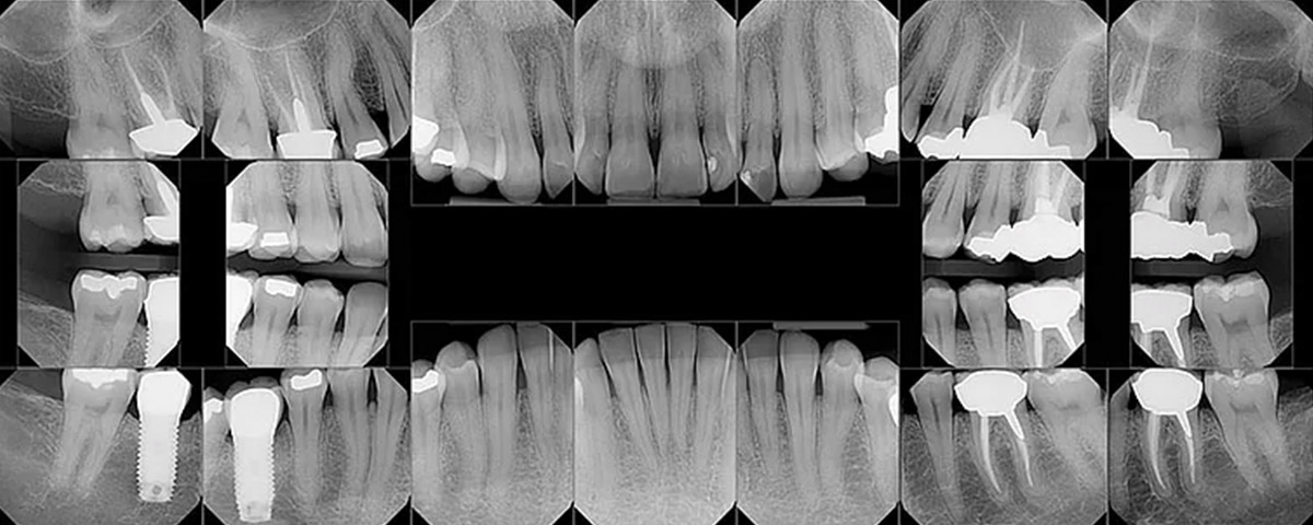 x ray teeth maintenance therapy 01