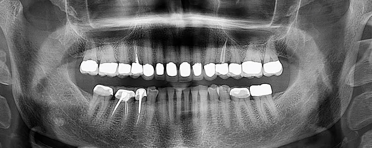 x ray teeth maintenance therapy 02